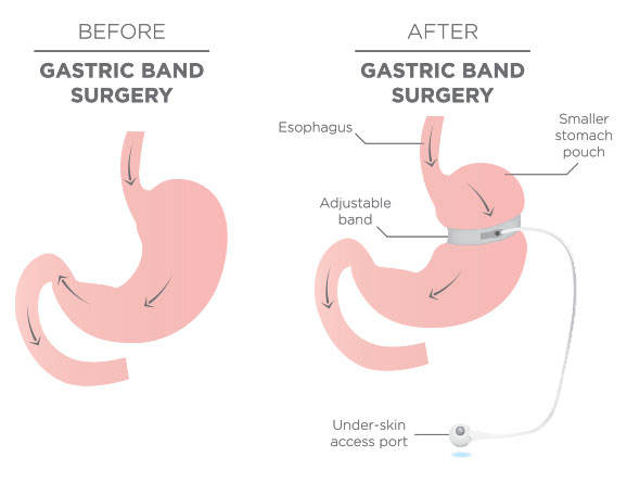 Gastric Sleeve Surgery Before & After