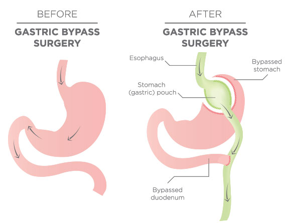 cat slabesti dupa gastric sleeve