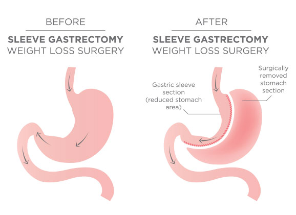 Gastric Sleeve Surgery Before & After