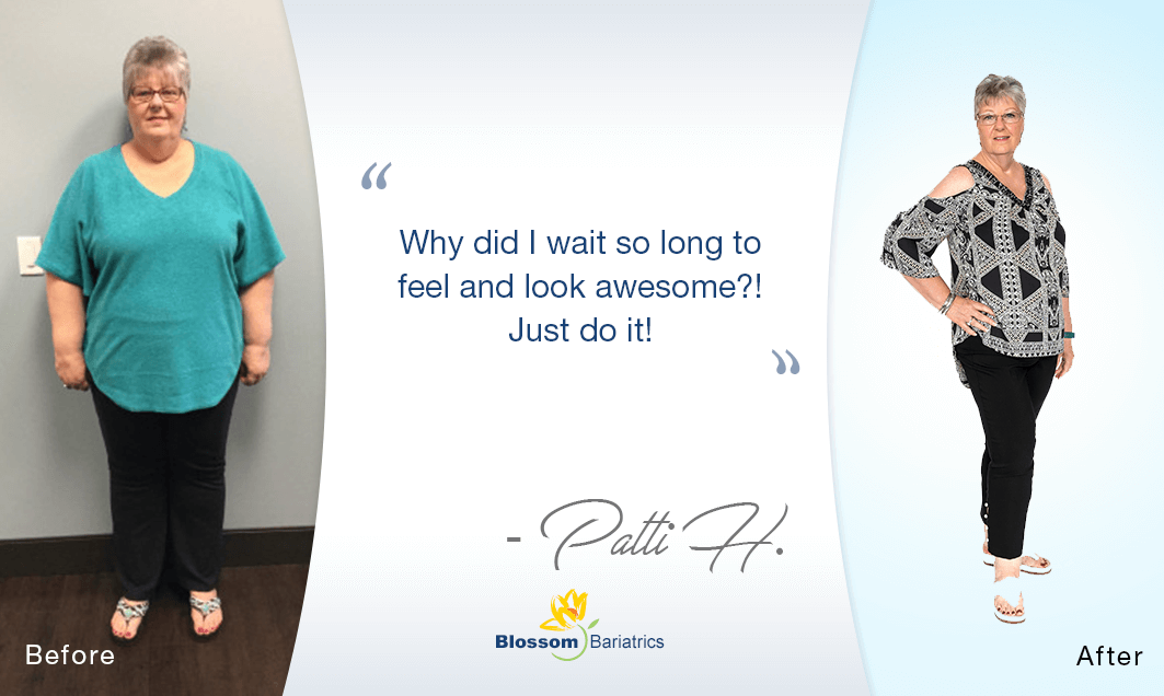 Patty H - Bariatric Weight Loss Before & After